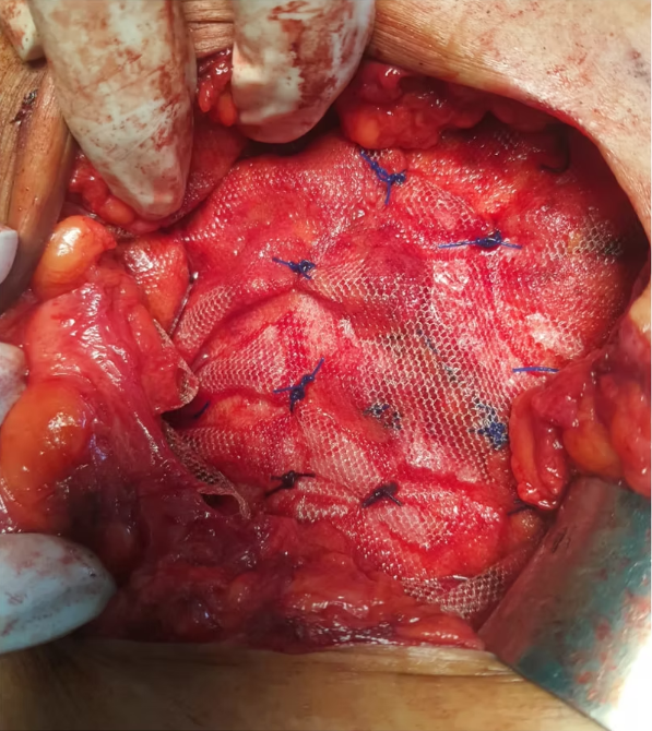 Large Umbilical Hernia and Mesh Repair After